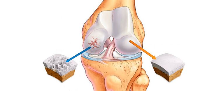 Deforméierend Arthrosis vum Kniegelenk (lénks) an e gesonde Gelenk (riets)