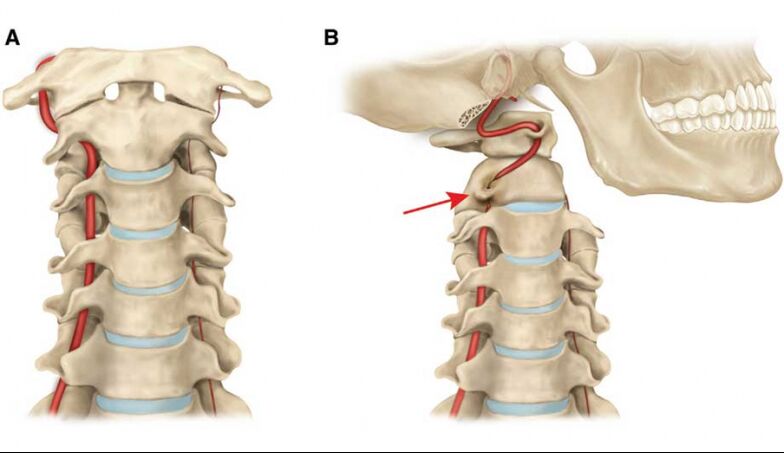 Kurs vun der vertebral Arterie