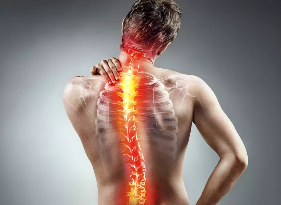 spinal Osteochondrose